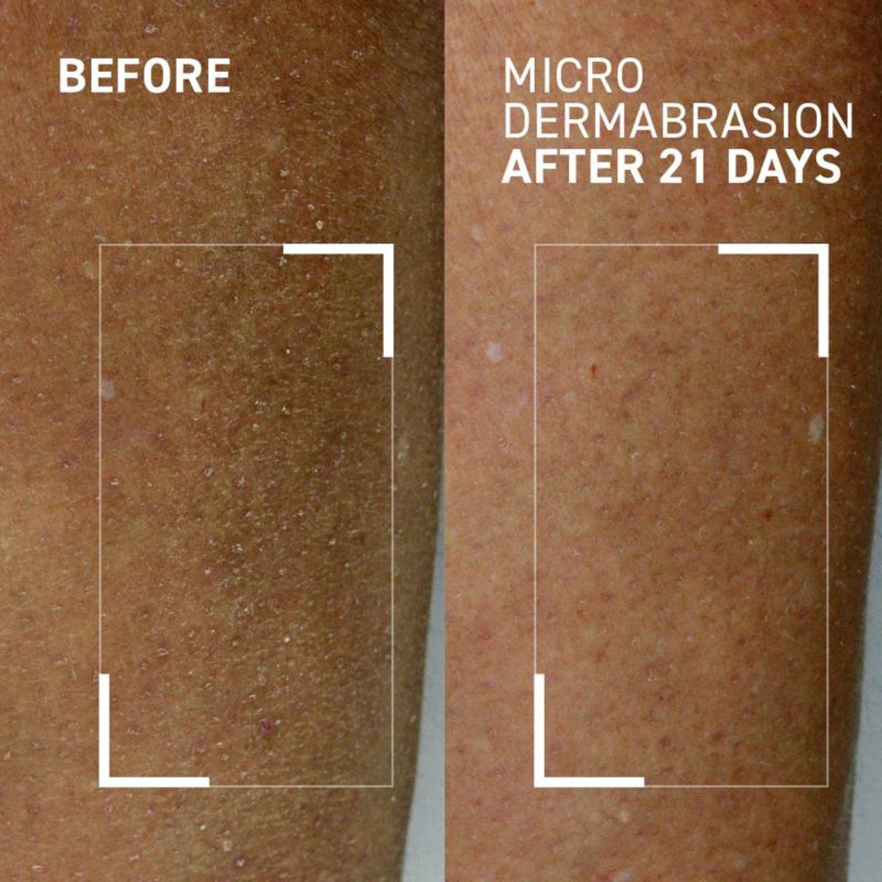 Microdermabrasion Body Polishing Exfoliator